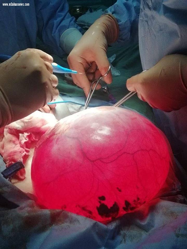 استئصال ورم كبير يزن 14 كيلو من مبيض سيدة بمدينة دسوق