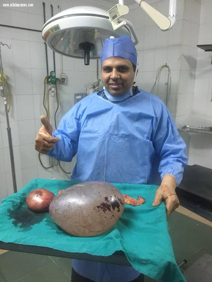 استئصال ورم كبير يزن 14 كيلو من مبيض سيدة بمدينة دسوق