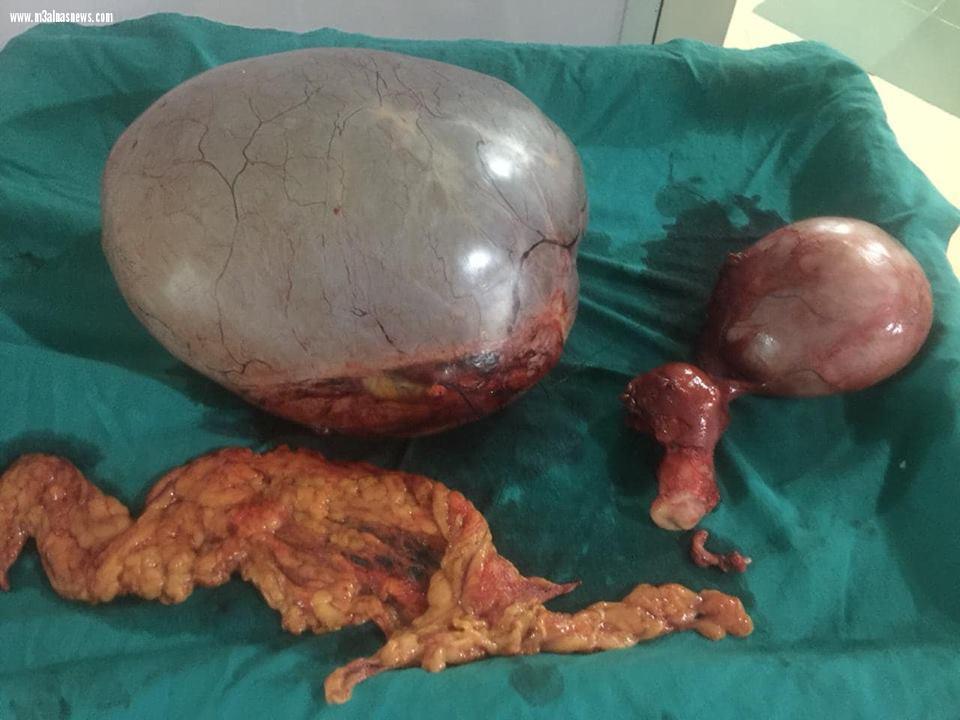 استئصال ورم كبير يزن 14 كيلو من مبيض سيدة بمدينة دسوق