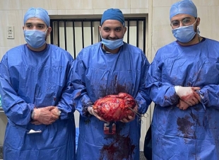 فريق طبي بمستشفيات جامعة أسيوط ينجح في استئصال ورم ضخم يزن 12 كيلو جراما في القولون